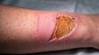 © Leo Lens - Severe second degree burn wound healing with skin graft and thick necrotic eschar scab