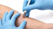 © Agnes - Close-up of a dermatologist performing a punch biopsy on a mole for skin cancer screening