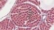 © PicsPro - Microscopic view of a hepatic nodule with regenerating liver cells in tissue section histology pathology microscope biomedical diagnosis biological microscopic condition clinical hepatocyte