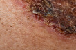 ©  BanuClick - Crusted Healing Skin Wound Close Up Showing Scab, Inflammation and Tissue Repair for Dermatology, Wound Care and Clinical Medical Research