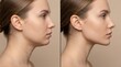 © Touch Heart Photo - Woman showing double chin lift concept with before and after face contour correction.