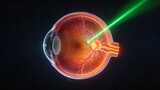 Retinal Laser Photocoagulation