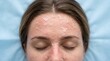 © Elowen - High angle close up of woman face with peeling skin after chemical peel treatment
