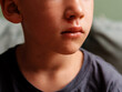 © B Krokodil/Stocksy - Close-Up Portrait Of Anonymous Child With Injury On His Face