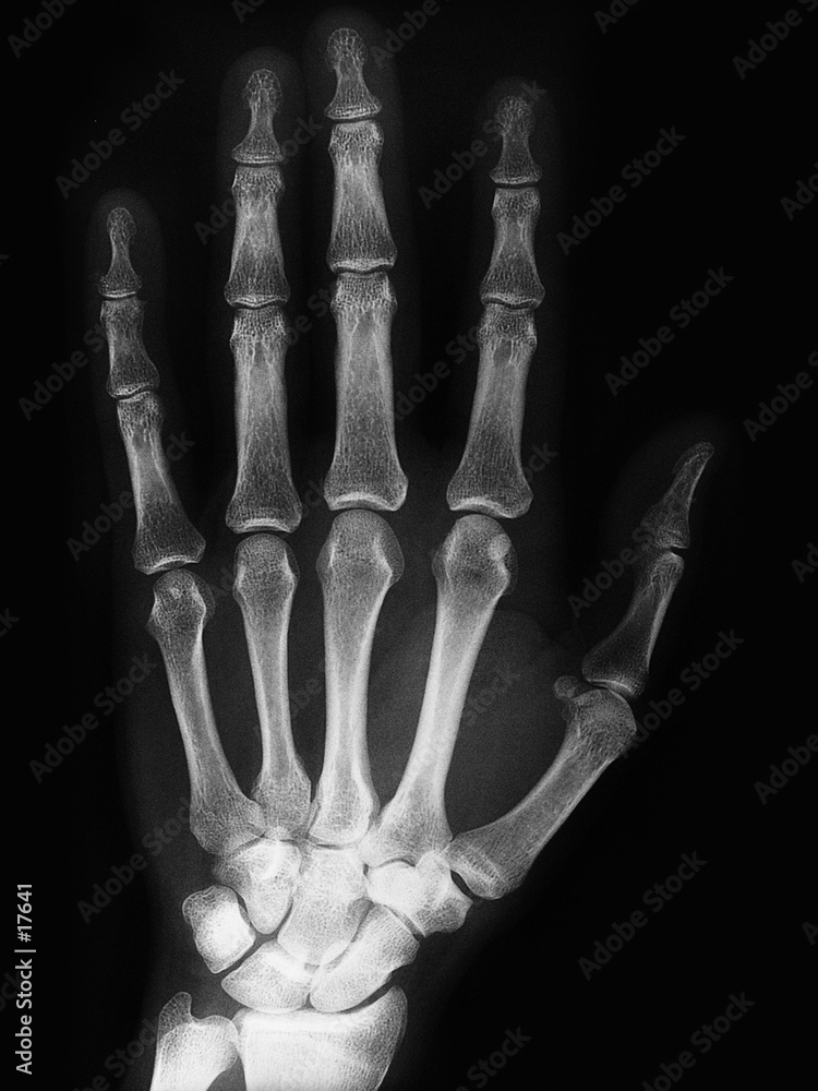 Radiographie D Une Main Gauche Stock Photo Adobe Stock