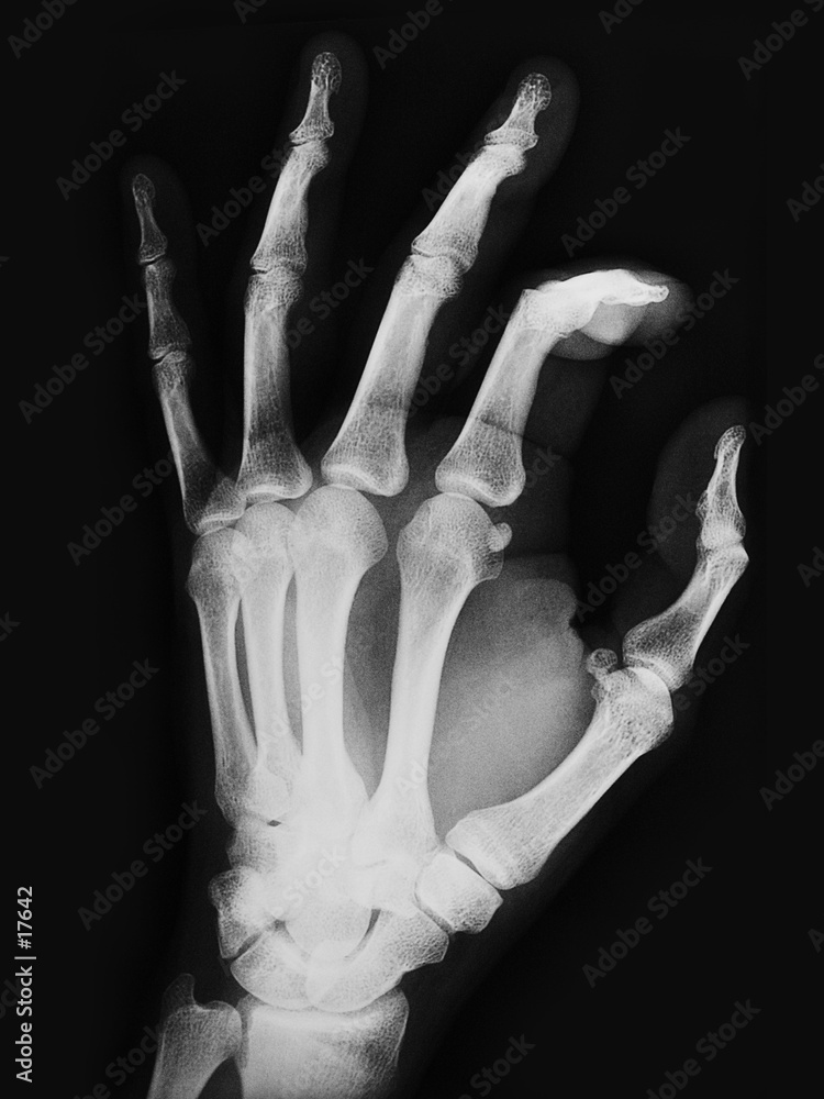 radiographie d'une main gauche Photos | Adobe Stock