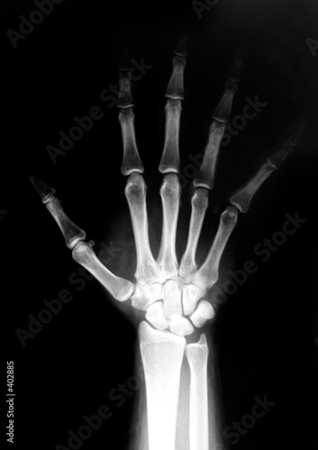 hand radiograph