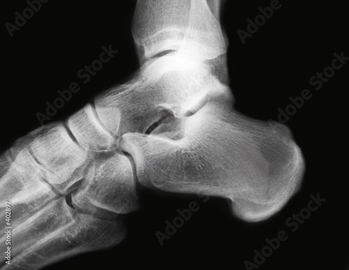 ankle x-ray