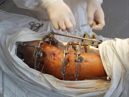 leg operated by ilizarov's method