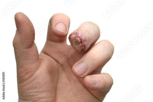 missing fingernail