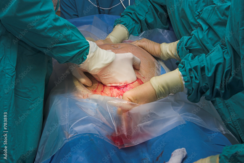 Photography cesarean section birth