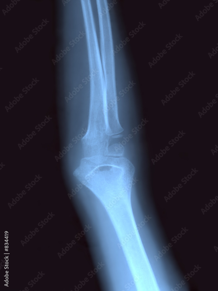 x ray x ray