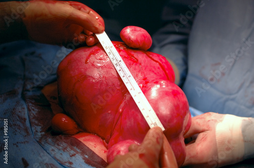 extraordinary diseased uterus