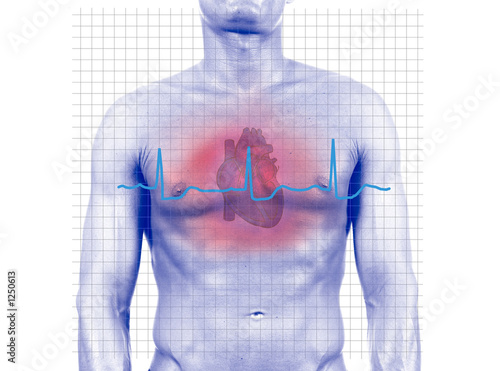heart attack