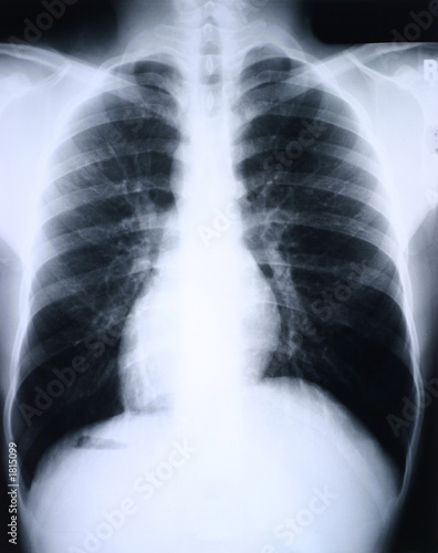 xray