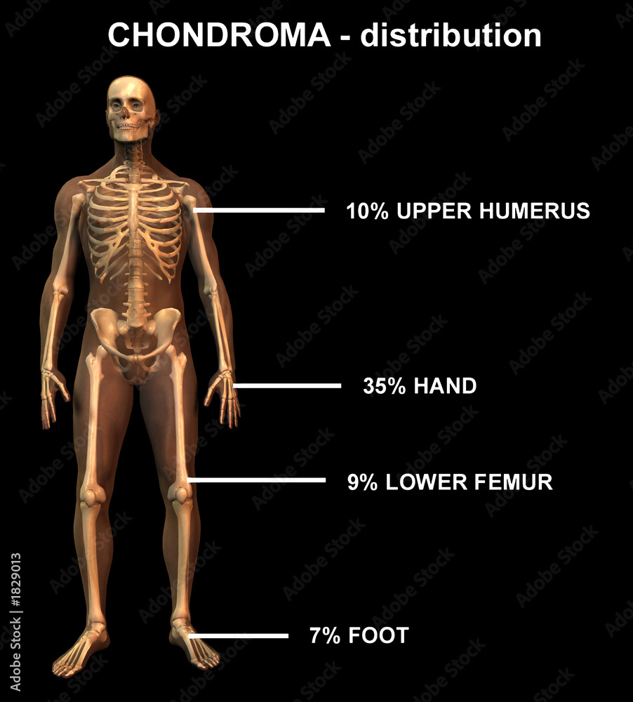 chondroma