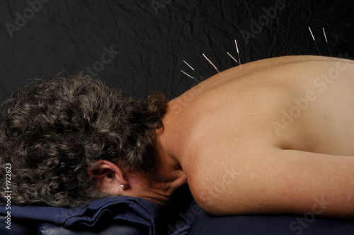 acupuncture on back of woman