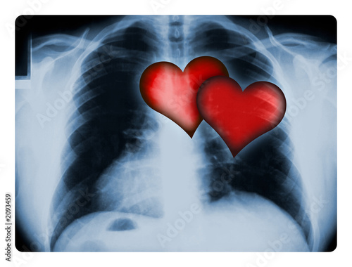 x-ray and two hearts