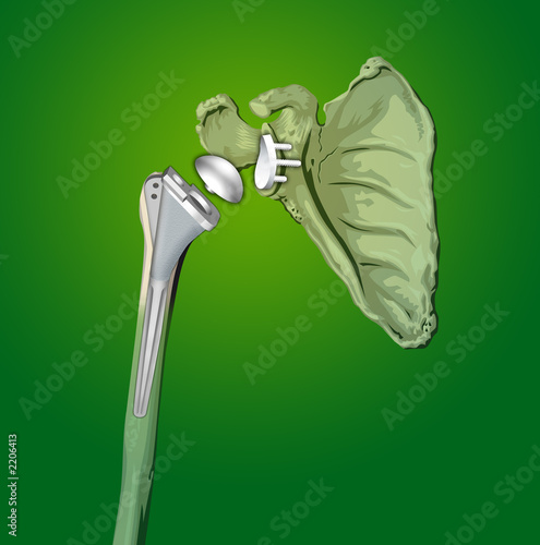 protesi spalla