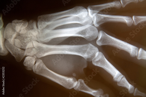 x-ray of hand