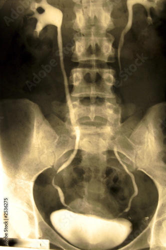 bladder xray