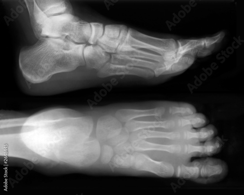 foot-x-ray