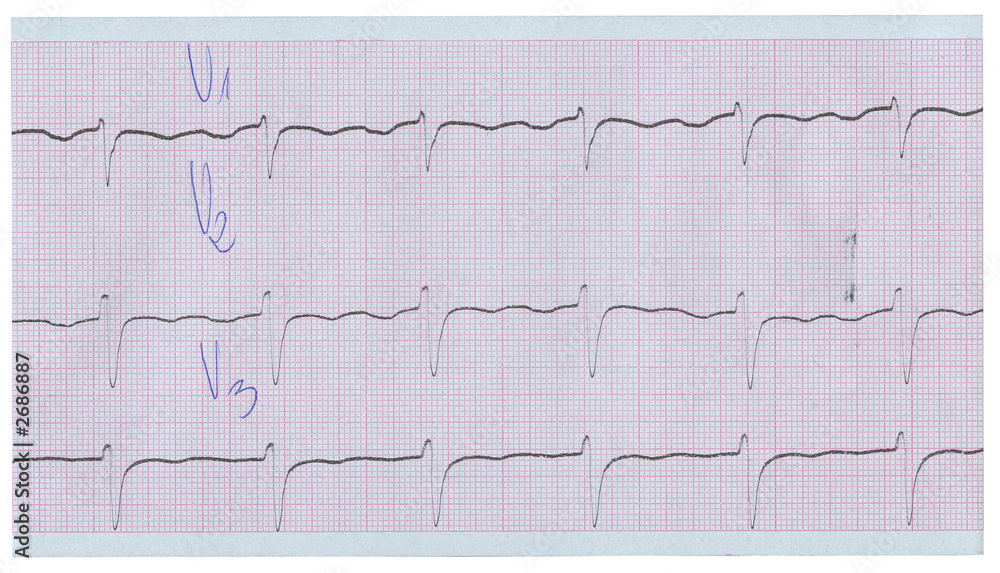 long stripe of ecg long stripe of ecg