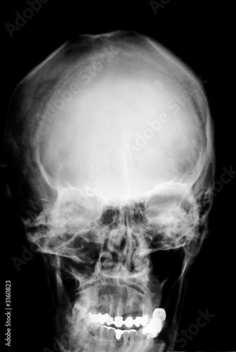 x-ray of deformed skull