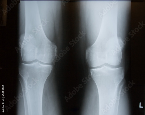 X-Ray Image of Knees.  Both Left and Right Legs are included.
