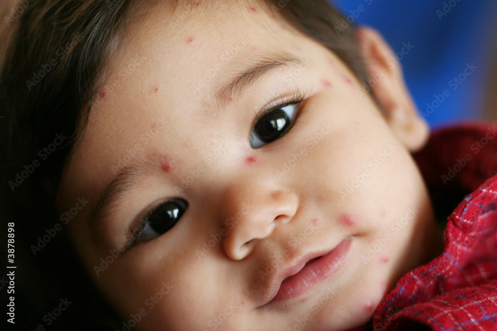 Baby with Chicken Pox Baby with Chicken Pox