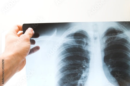 x-ray picture of human chest
