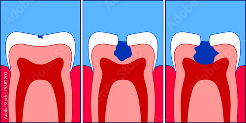 Caries