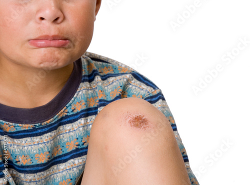 Boy with a sad face and a skinned knee. Focus on knee.