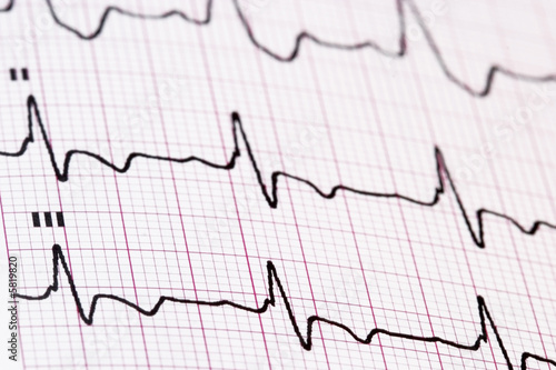 EKG - medical background