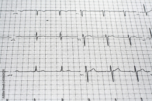 EKG Readout