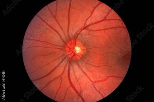 Retina - Optic Nerve - Human Eye photo
