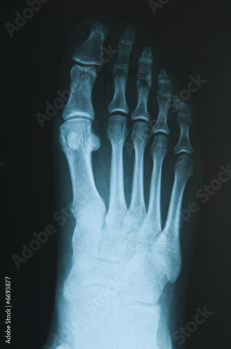Radiografia del piede