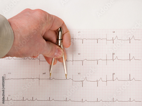 Doctor Measuring EKG Intervals With Calipers