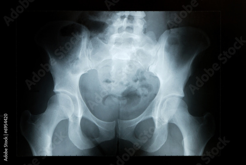 Pelvis X-ray