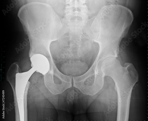 Radiographie Prothèse totale de hanche 