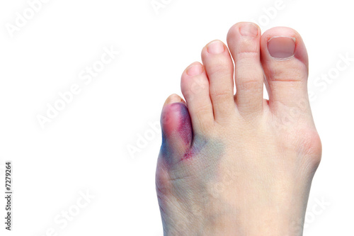 Bruises, bunions  and broken toes