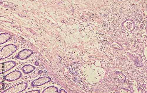 Foto Colon Cancer Histology