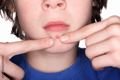 Fotografía Picking at a Pimple