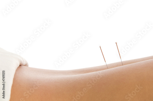 Acupuncture