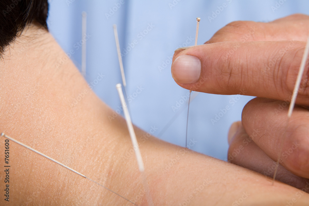 Acupuncture needles on back of a young woman Acupuncture needles on back of a young woman