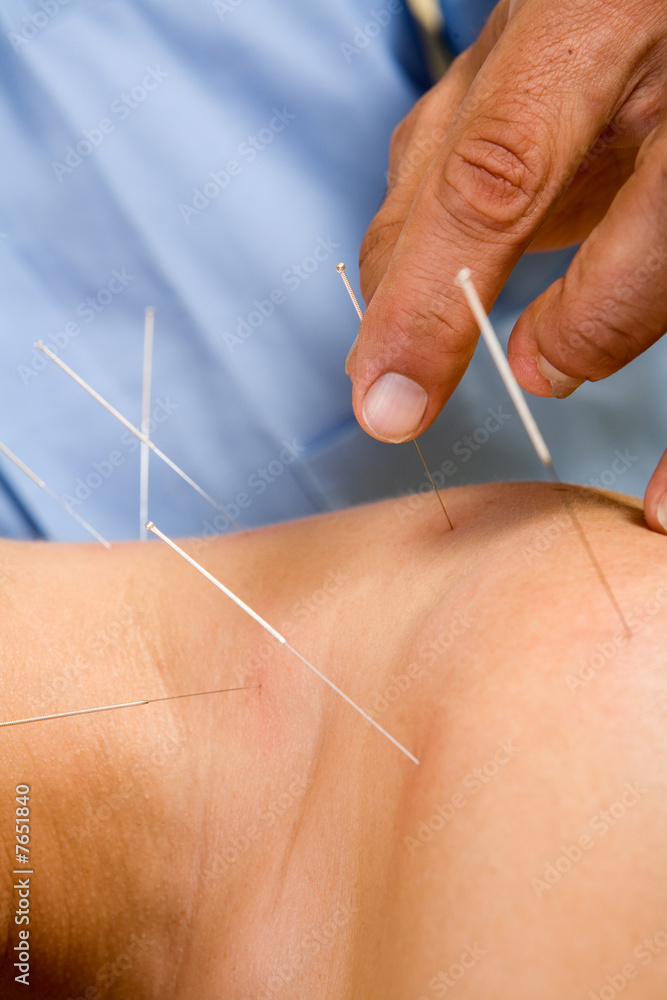 Acupuncture needles on back of a young woman Acupuncture needles on back of a young woman