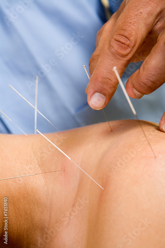 Acupuncture needles on back of a young woman