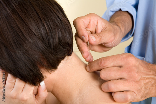 Acupuncture needles on back of a young woman
