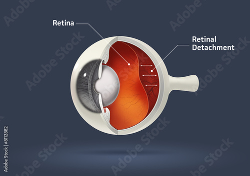 Retinal detachment photo