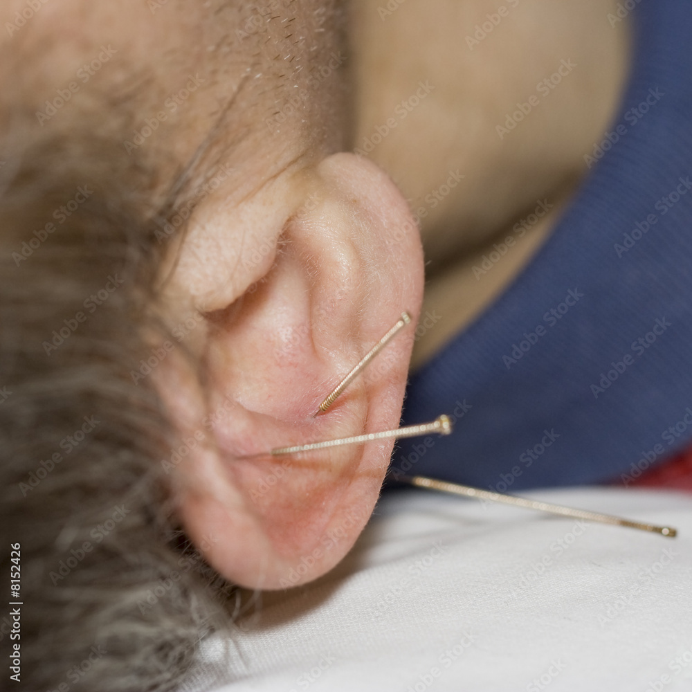 Man with acupuncture needles in his ear Man with acupuncture needles in his ear
